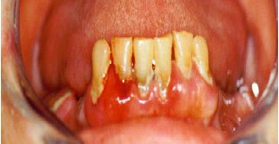 periodontitida